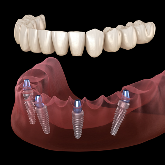 Illustration of an All on X implant denture being placed