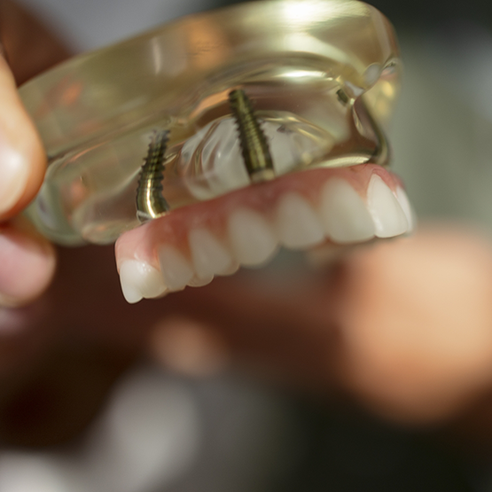 Model of the mouth with dental implants in Braintree replacing missing teeth