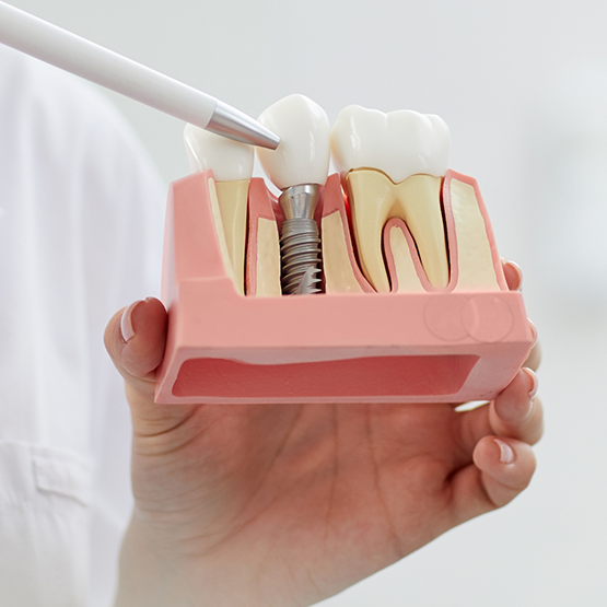 Dentist holding a model of a dental implant