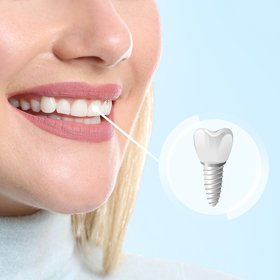 Close up of a woman smiling with a dental implant