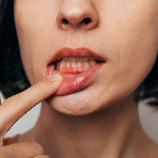 Woman pointing to her receding gums before gum disease treatment in Braintree