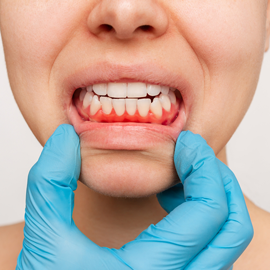 Close up of a person revealing their red gums