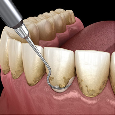 Illustration of a dental scaler clearing tartar buildup from the gums