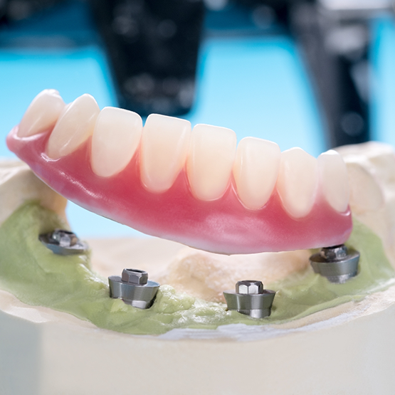 Model of an implant denture in Braintree