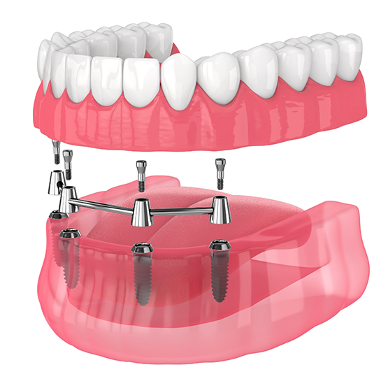 Illustration of a denture supported by four dental implants