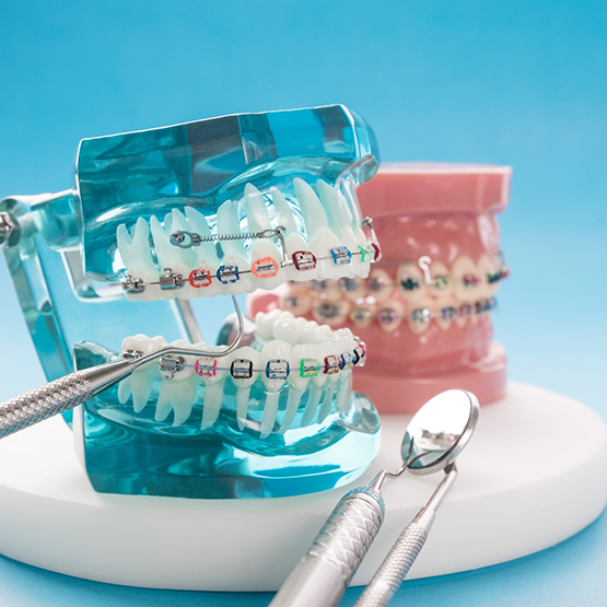 Two models of the teeth with braces