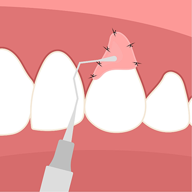 Illustrated tissue being grafted in receding gums