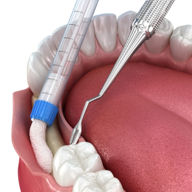 Illustration of tissue being placed to thicken the gums